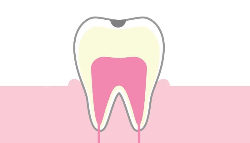 ＜C1＞歯の表面の虫歯