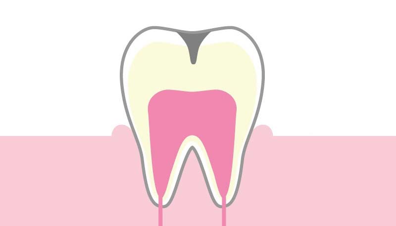 ＜C2＞歯の内面の虫歯