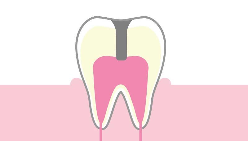 <C3>歯の神経にまで達した虫歯