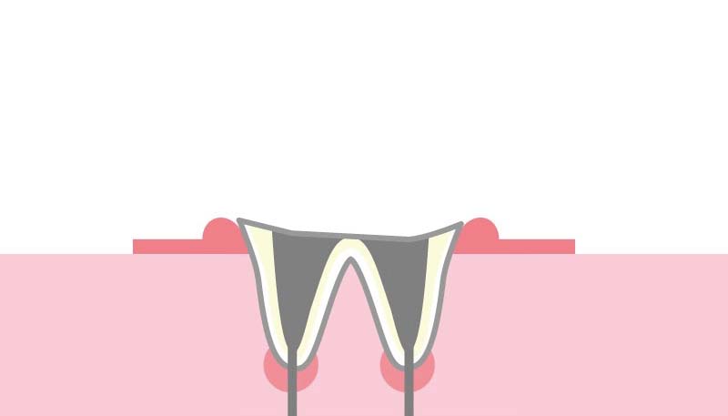 ＜C4＞歯の根元のみ残っている虫歯